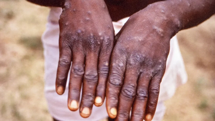 What is Mpox? How does it affect people?