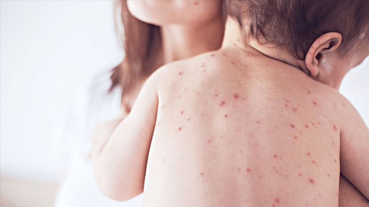 Measles cases surging again in Europe: WHO