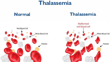Thalassemia: Genetic Disease
