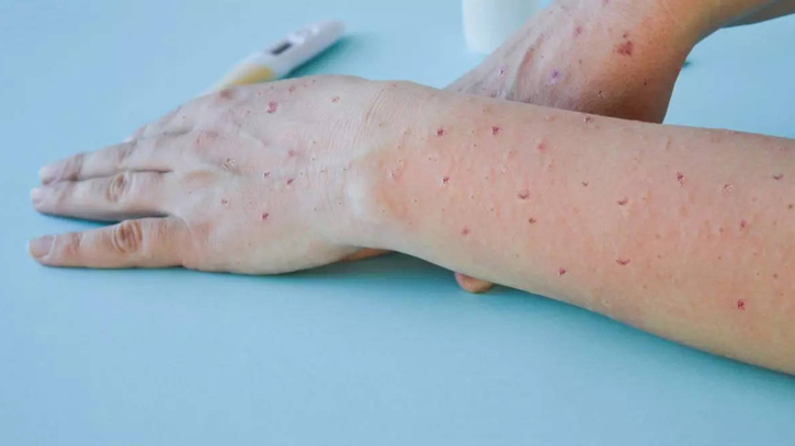 Thailand reports suspected case of new mpox strain